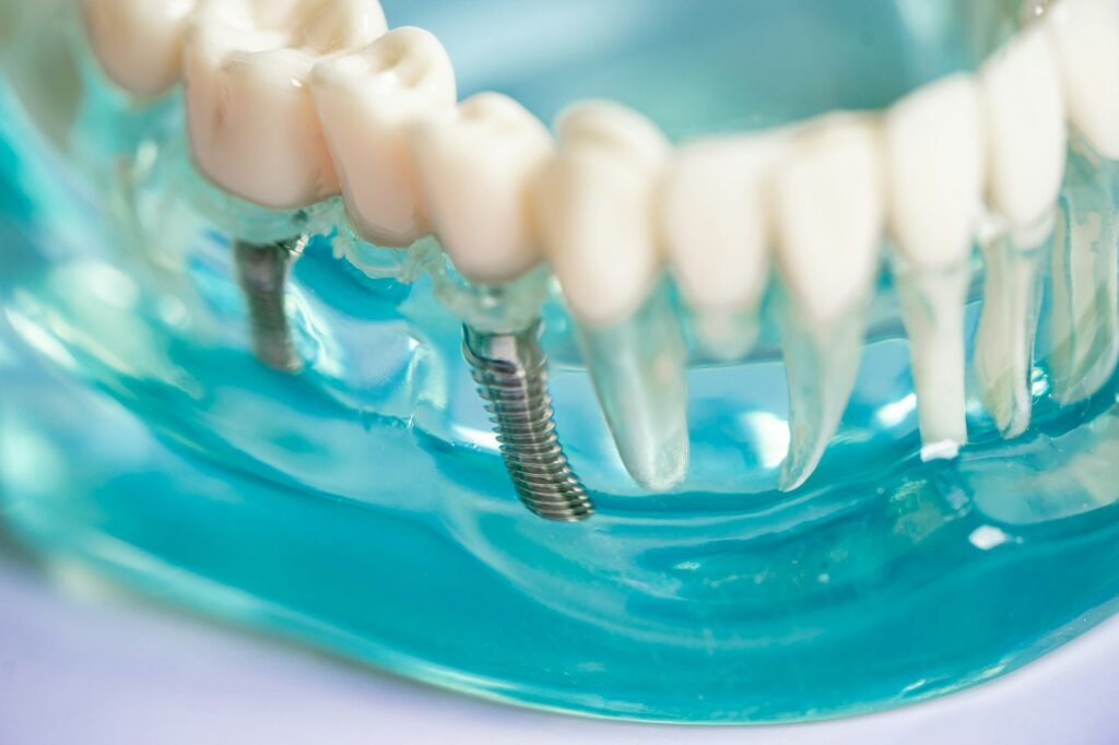 Dental implant, artificial tooth roots into jaw, root canal of dental treatment, gum disease