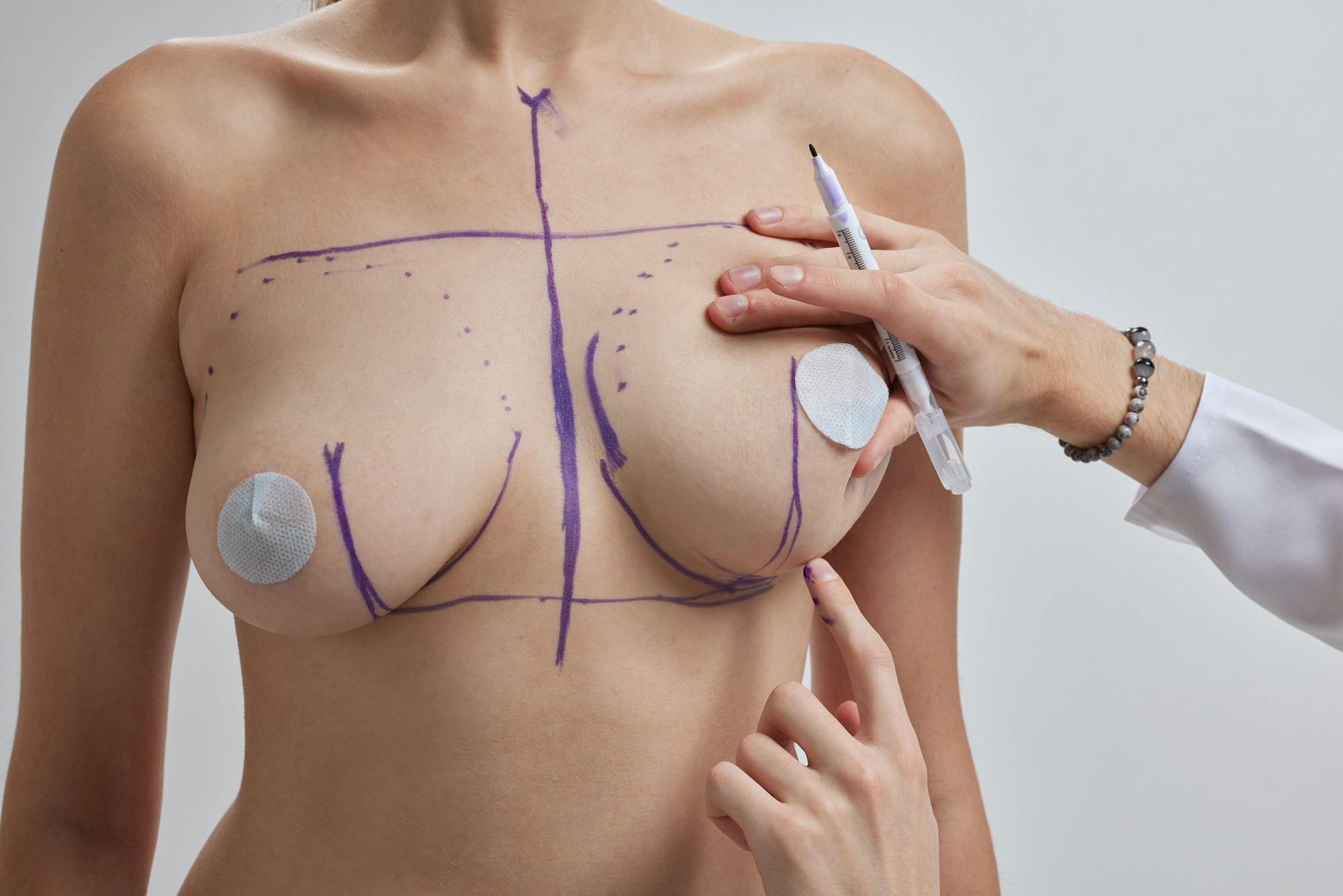 Doctor hand drawing lines on woman breast, breast implant surgery concept.