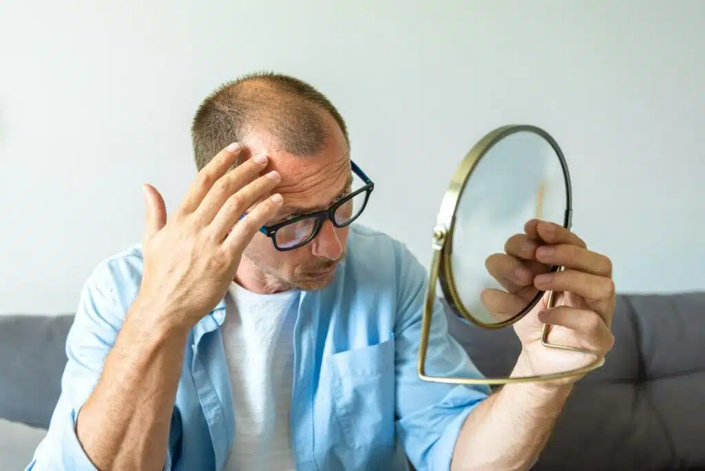 Male pattern hair loss problem concept. Young caucasian man looking at mirror worried about baldines