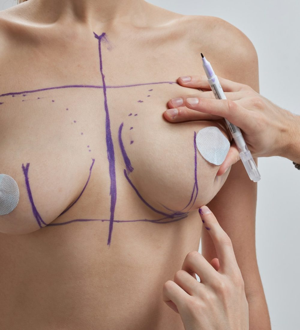 Doctor hand drawing lines on woman breast, breast implant surgery concept.